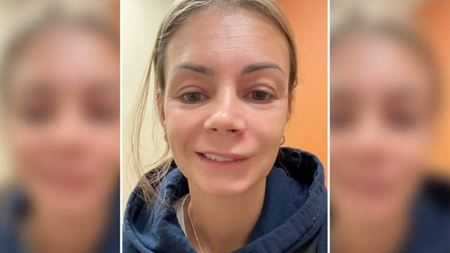 'Ölüm Üçgeni'nde sivilcesini patlatan kadın yüz felci geçirdi! Neredeyse canından oluyordu