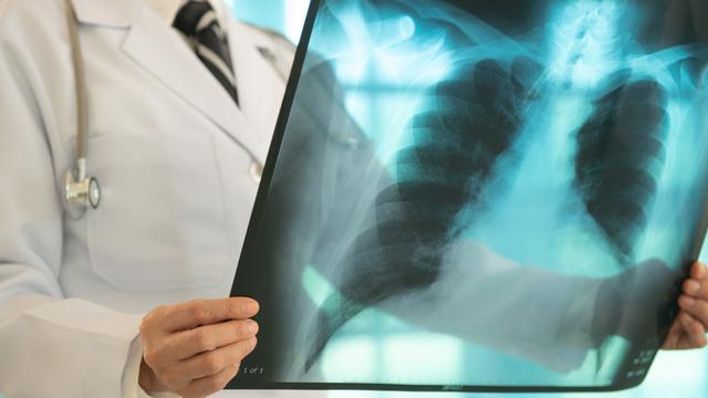 Akciğer hastalıkları en sık hangi belirtilerle kendini gösterir? Akciğer hastalığı belirtileri