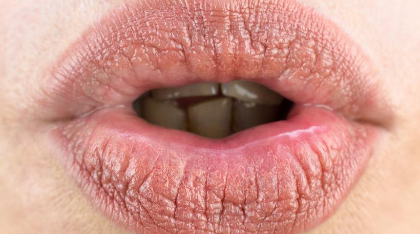 Dudak kuruluğu nedir, neden olur? Dudak kuruluğu nasıl geçer?