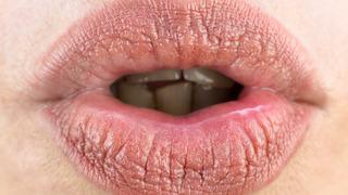 Dudak kuruluğu nedir, neden olur? Dudak kuruluğu nasıl geçer?