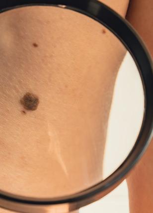 Erken teşhisin önemi: Cilt kanserinde farkındalık