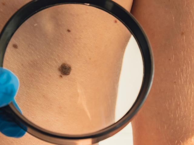 Erken teşhisin önemi: Cilt kanserinde farkındalık