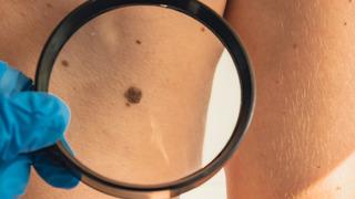 Erken teşhisin önemi: Cilt kanserinde farkındalık