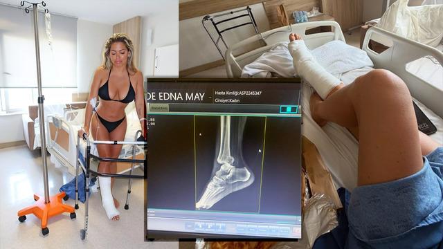 Ünlü model Türkiye tatilinde ayak bileğini kırdı... Bikinili pozunun altına yorum yağdı!