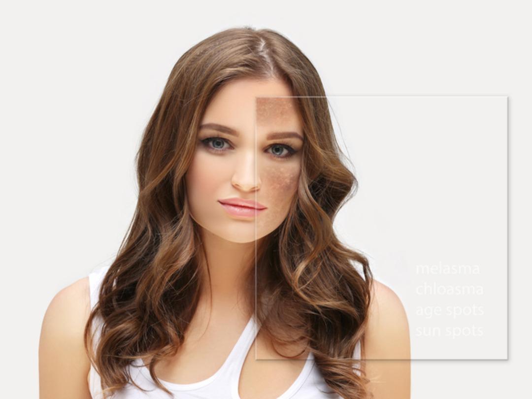 MYNET ÖZEL | Yaz lekeleri cildinizde çukur kazmasın! Leke tedavisinde en sık görülen 6 yanlış! Evde leke tedavisi yapılır mı? Uzman isim uyardı… 5