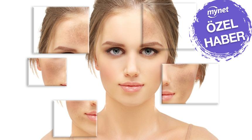 MYNET ÖZEL | Yaz lekeleri cildinizde çukur kazmasın! Leke tedavisinde en sık görülen 6 yanlış! Evde leke tedavisi yapılır mı? Uzman isim uyardı…