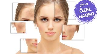MYNET ÖZEL | Yaz lekeleri cildinizde çukur kazmasın! Leke tedavisinde en sık görülen 6 yanlış! Evde leke tedavisi yapılır mı? Uzman isim uyardı…