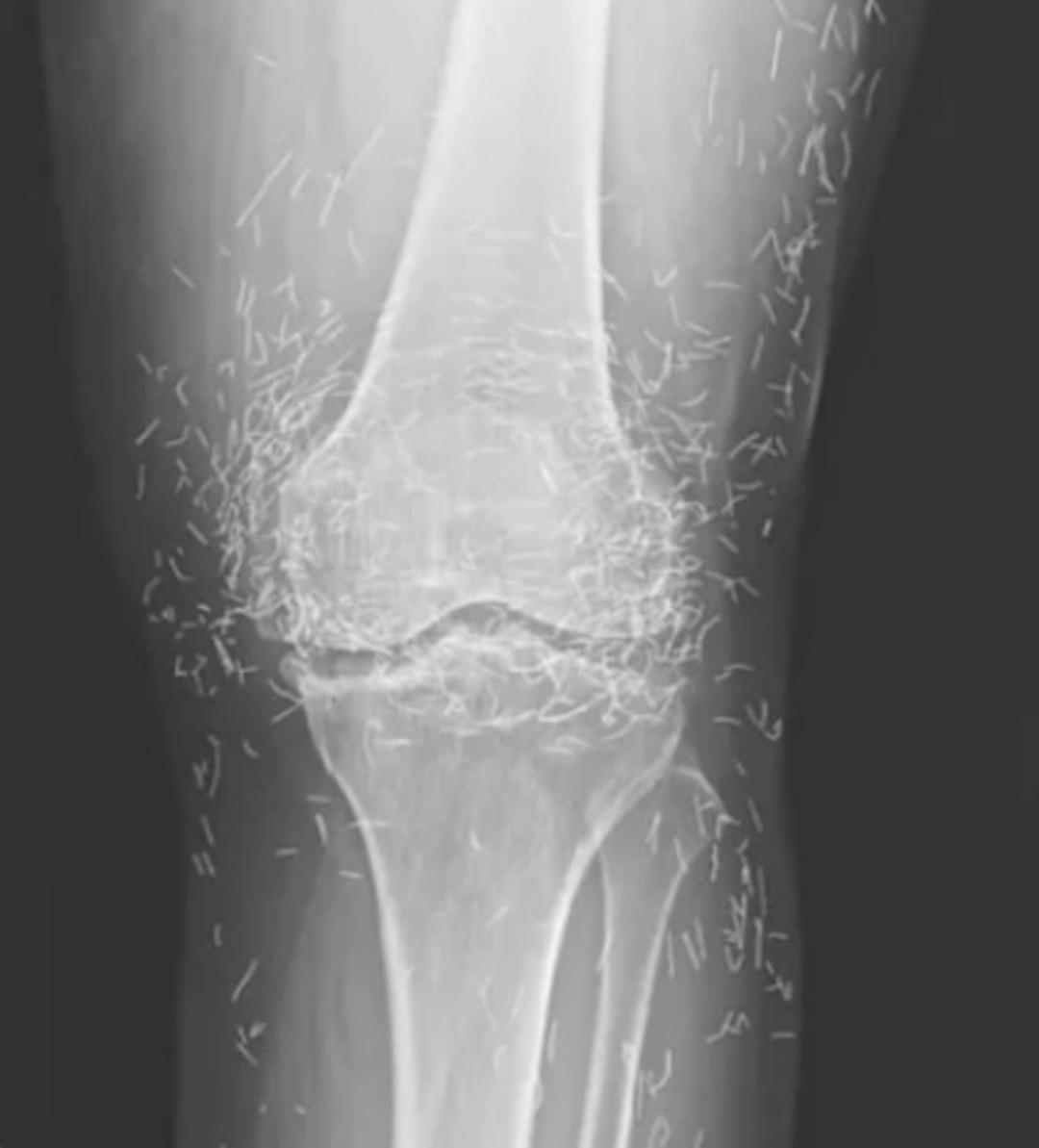 Tedavi diye yaptırdı, vücuduna yayıldı! Altın iplikler röntgenle ortaya çıktı... 1
