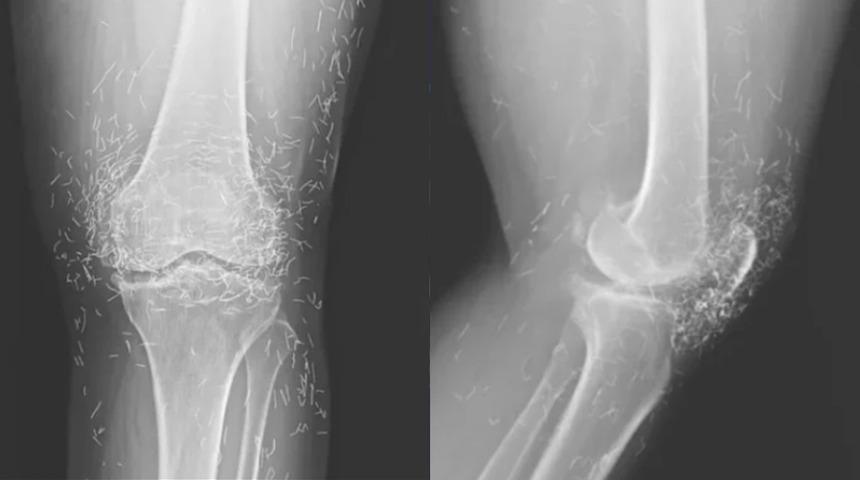 Tedavi diye yaptırdı, vücuduna yayıldı! Altın iplikler röntgenle ortaya çıktı...