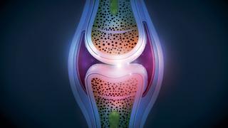 Dizlerde sıvı kaybı nasıl anlaşılır? Dizde sıvı kaybı belirtileri nelerdir?