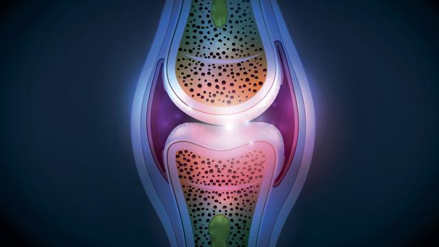 Dizlerde sıvı kaybı nasıl anlaşılır? Dizde sıvı kaybı belirtileri nelerdir?