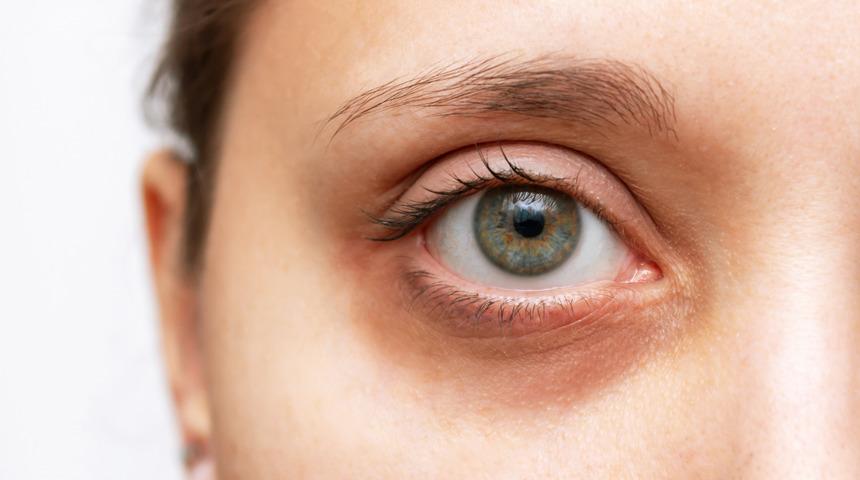 Göz altı morlukları hangi hastalıkların habercisi olabilir? Göz altı morluklarının nedenleri