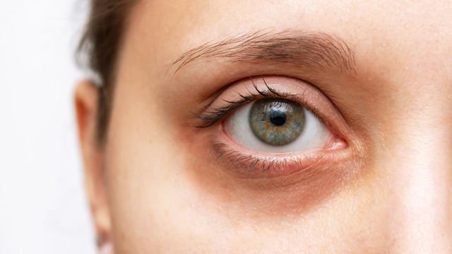 Göz altı morlukları hangi hastalıkların habercisi olabilir? Göz altı morluklarının nedenleri