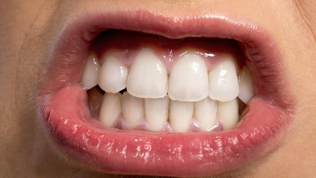Gece diş gıcırdatmak neden olur? Gece uykuda diş gıcırdatmak zararlı mı?