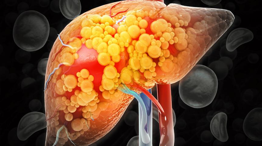 Karaciğer yağlanması nasıl fark edilir? Karaciğer yağlanması belirtileri