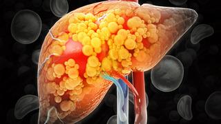 Karaciğer yağlanması nasıl fark edilir? Karaciğer yağlanması belirtileri