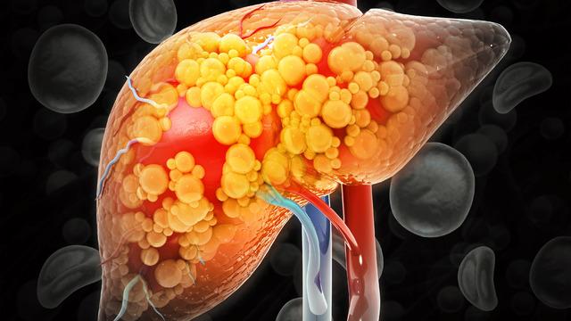 Karaciğer yağlanması nasıl fark edilir? Karaciğer yağlanması belirtileri