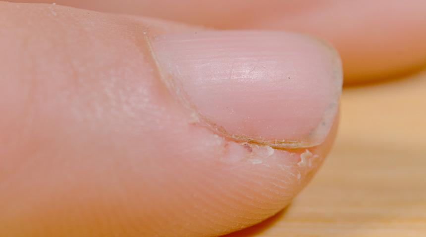 Ayak tırnaklarında kalınlaşma neden olur? Ayak tırnağı kalınlaşması nedenleri