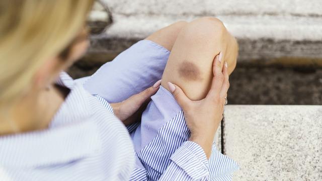 Vücutta morarma neden olur? Vücuttaki morlukları hangi hastalıkları gösterebilir?