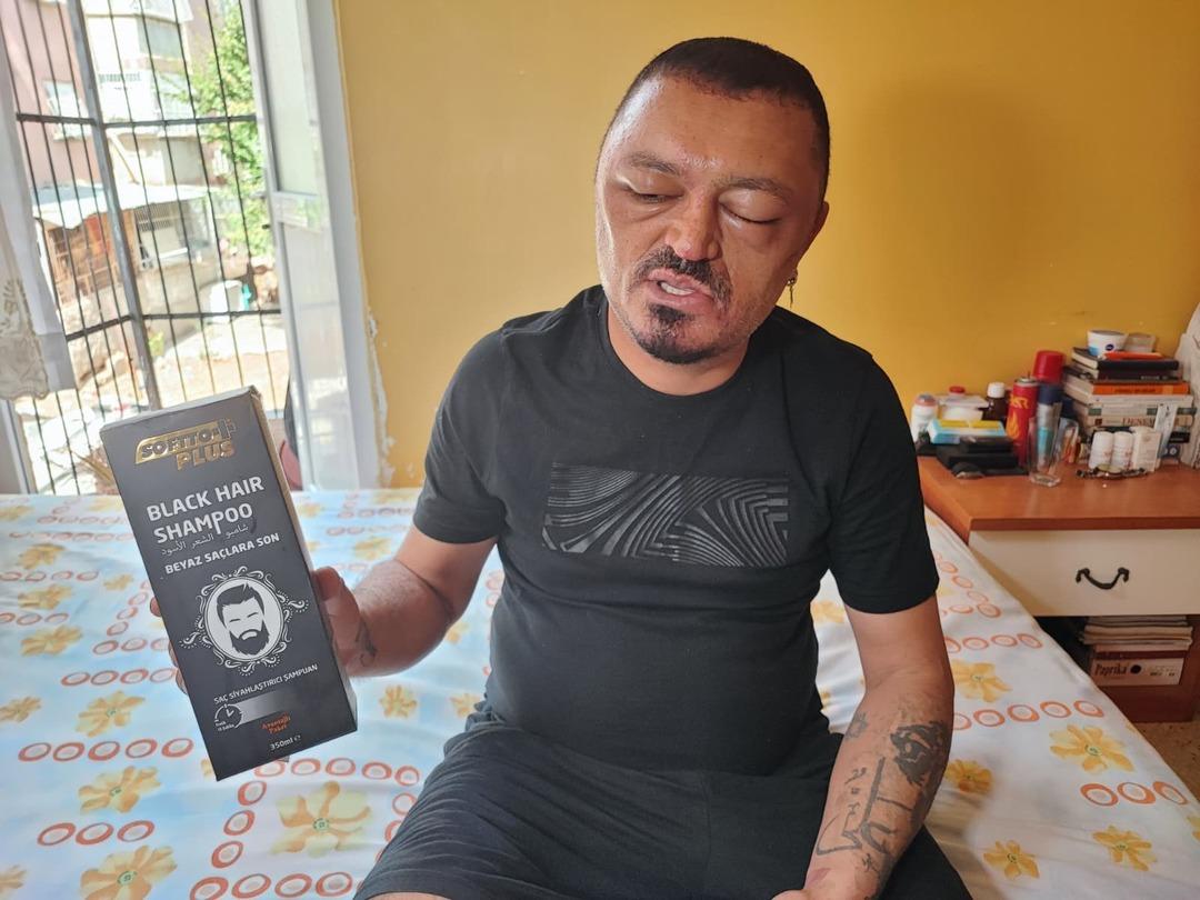 Yer: Adana! Berber tavsiyesi sonrası bu hale geldi! "Gözlerimi kaybedeceğim diye..." 3