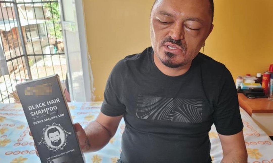 Saçlarındaki beyazları kapatmak istedi, hayatı karardı! İnternetten aldığı şampuan kabusu yaşattı 2
