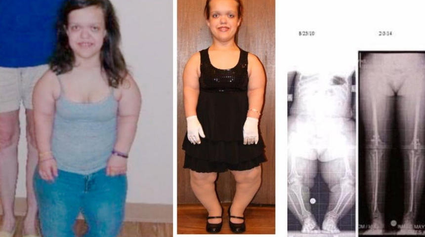 2 milyon dolar verdi! Cüceydi, boyunu 30 cm uzattı! İşte son hali