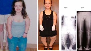 2 milyon dolar verdi! Cüceydi, boyunu 30 cm uzattı! İşte son hali