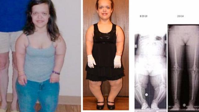 2 milyon dolar verdi! Cüceydi, boyunu 30 cm uzattı! İşte son hali