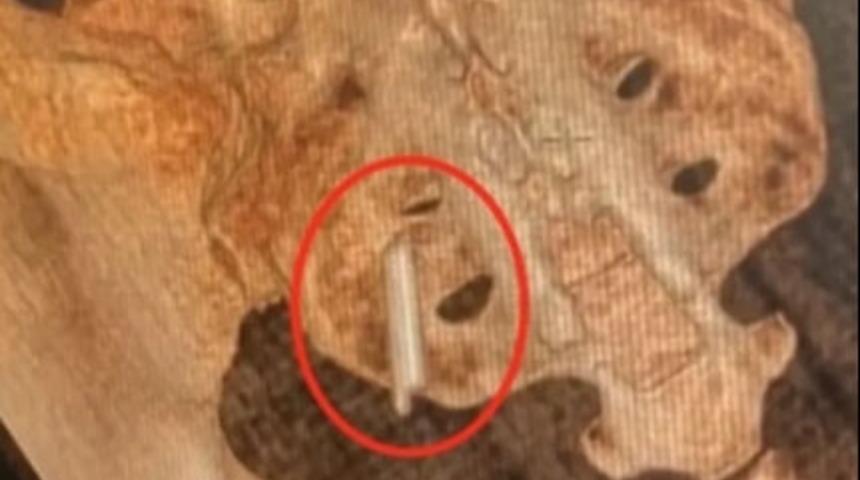 Doktorlar g&ouml;r&uuml;nce şaştı kaldı! 22 yıl boyunca kal&ccedil;asında yaşamış! 