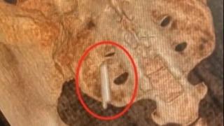 Doktorlar görünce şaştı kaldı! 22 yıl boyunca kalçasında yaşamış! 