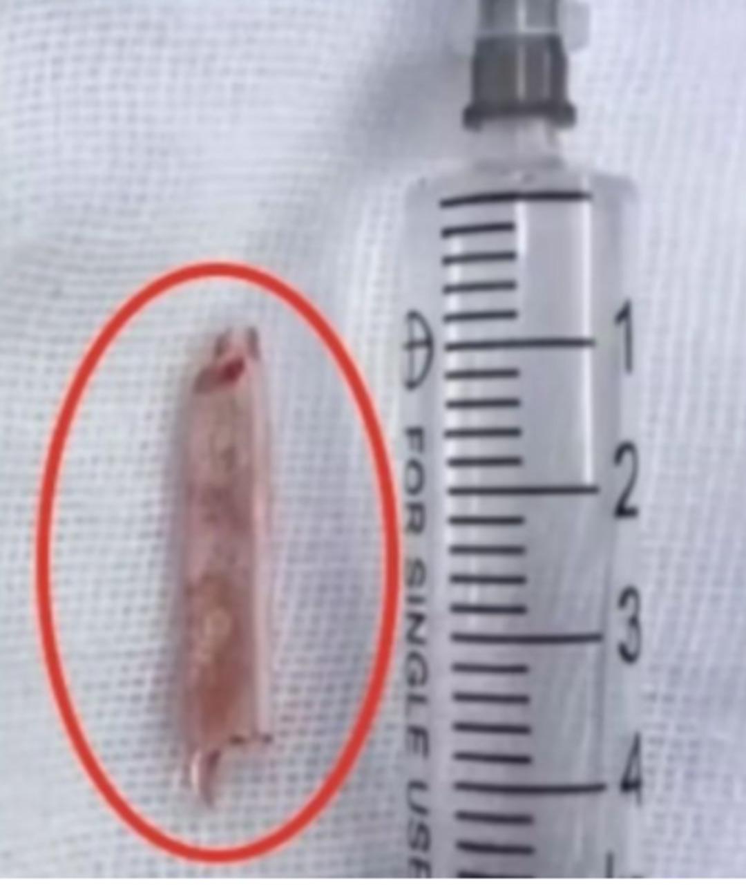 Doktorlar g&ouml;r&uuml;nce şaştı kaldı! 22 yıl boyunca kal&ccedil;asında yaşamış!  1