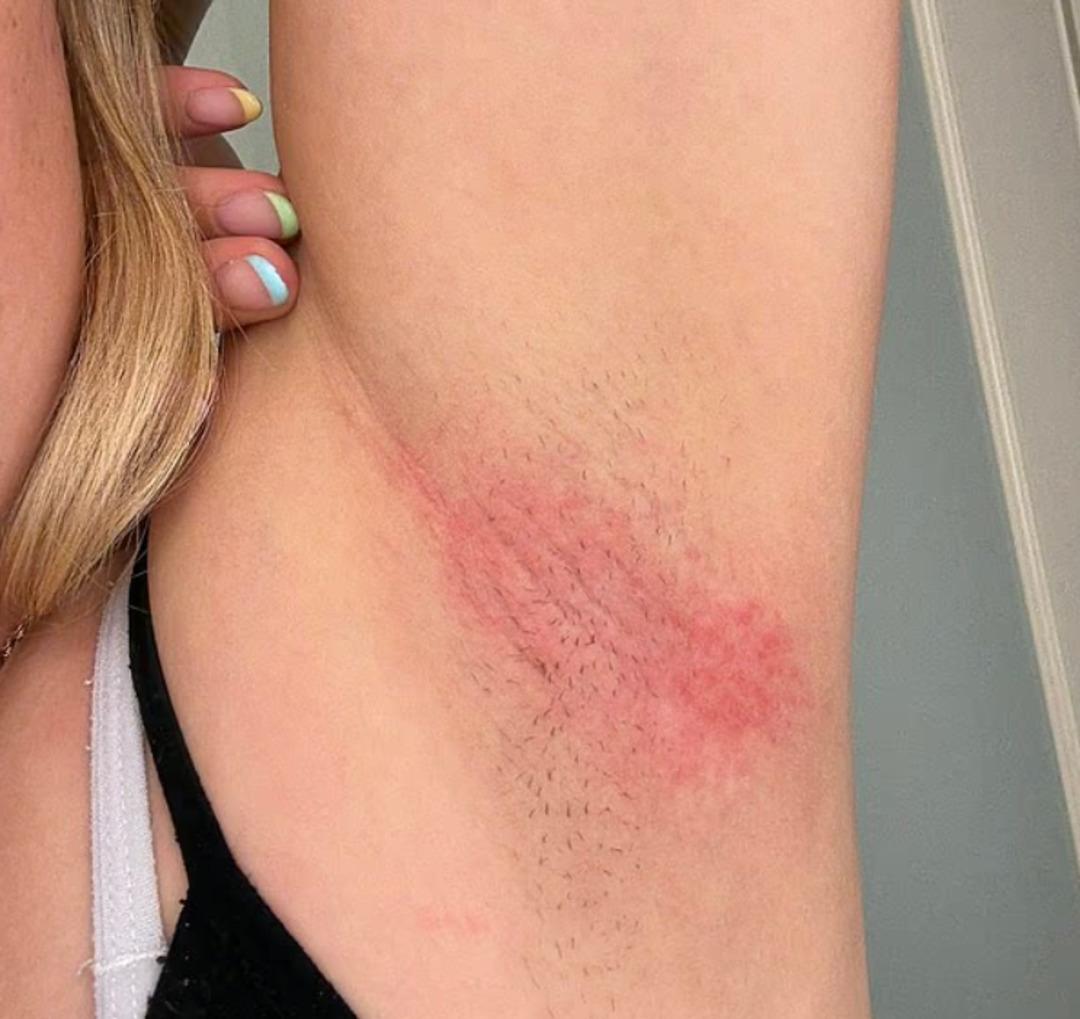 Yanıklar, tahriş ve enfeksiyon... Kötü kokuyu önlemeye çalışırken tüm müşterileri sağlığından oldu! Marka alarma geçti: Geri çağırılıyor 2