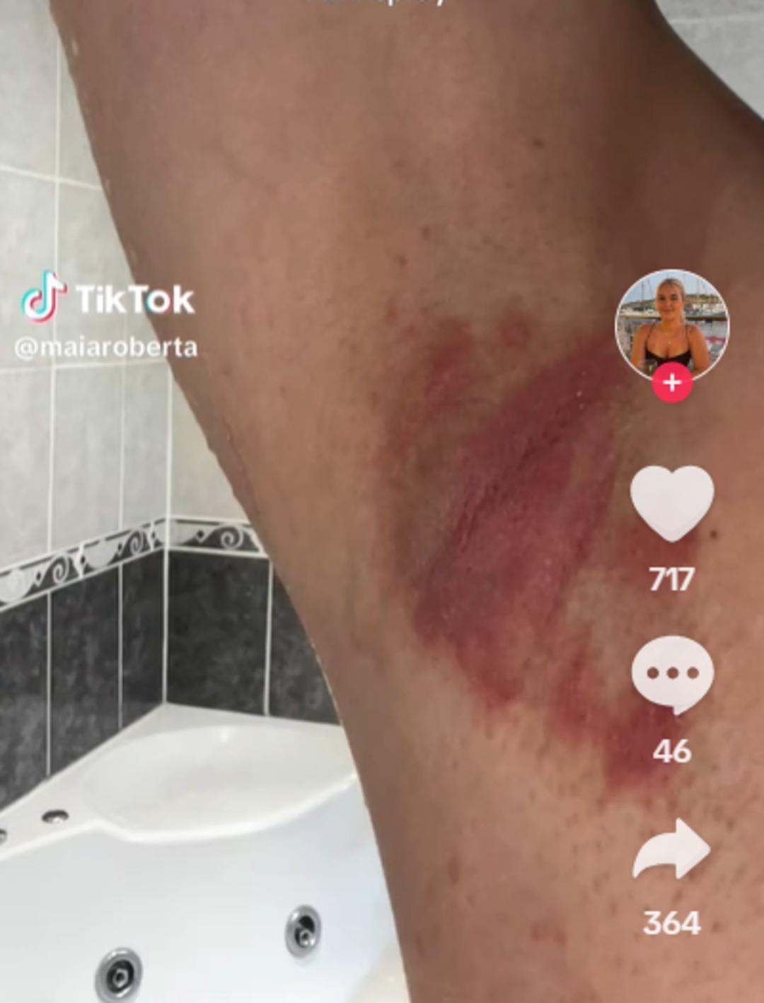 Yanıklar, tahriş ve enfeksiyon... Kötü kokuyu önlemeye çalışırken tüm müşterileri sağlığından oldu! Marka alarma geçti: Geri çağırılıyor 1