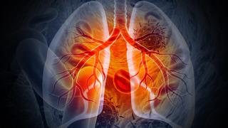 ABD dış yardımları kesecek açıklaması: 2 milyondan fazla kişi tüberkülozdan ölebilir!