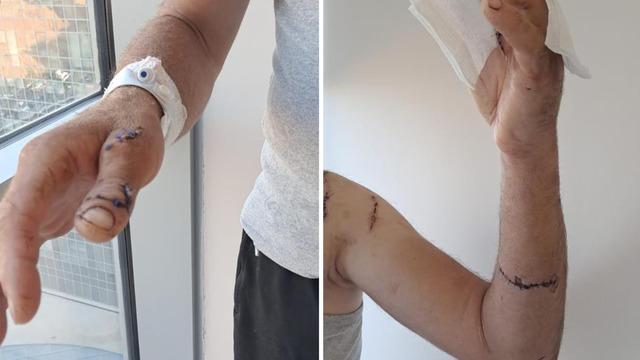 Ayının saldırısına uğrayan çiftçi dehşet anlarını anlattı: Parmağımı kopardı