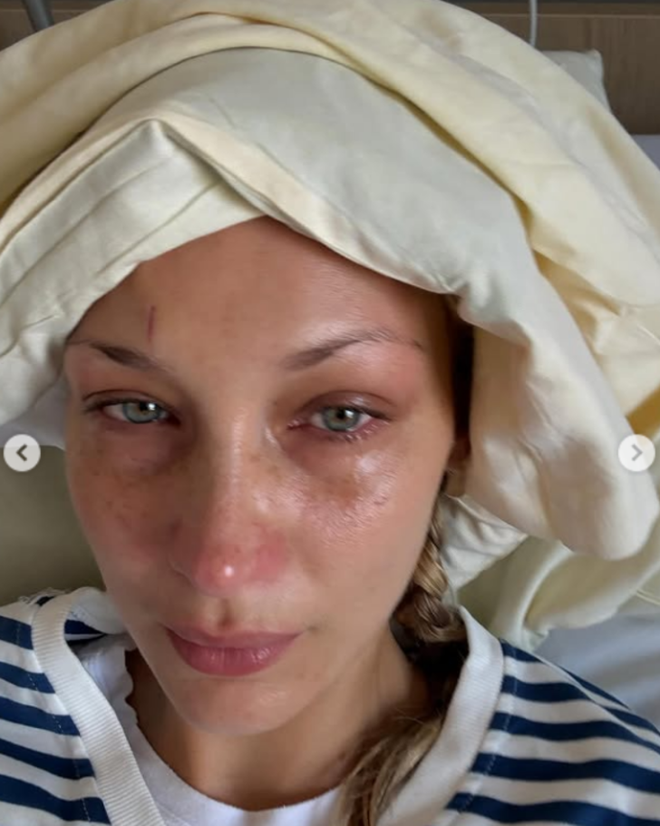 Bella Hadid'in hastalığı ne? Ünlü model tedavi anlarını paylaştı G2