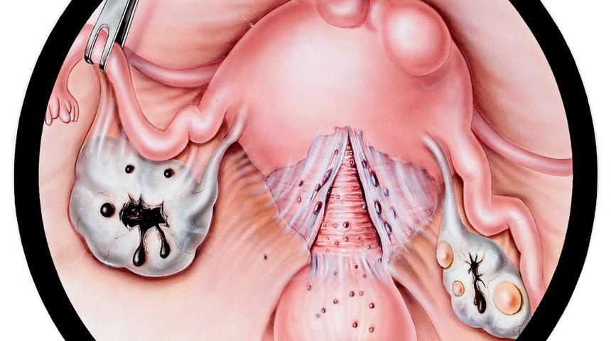 Anne olmayı önleyen sinsi tehlike!
