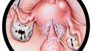 Anne olmayı önleyen sinsi tehlike!