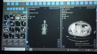 Van'dan dünyaya örnek çalışma: Kanser tedavisinde yapay zekâ kullanıldı