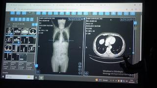 Dünyaya örnek oldu! Türkiye’de bir ilk: Kanser tedavisinde yapay zeka kullanıldı