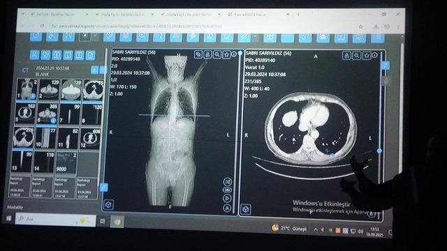 Dünyaya örnek oldu! Türkiye’de bir ilk: Kanser tedavisinde yapay zeka kullanıldı