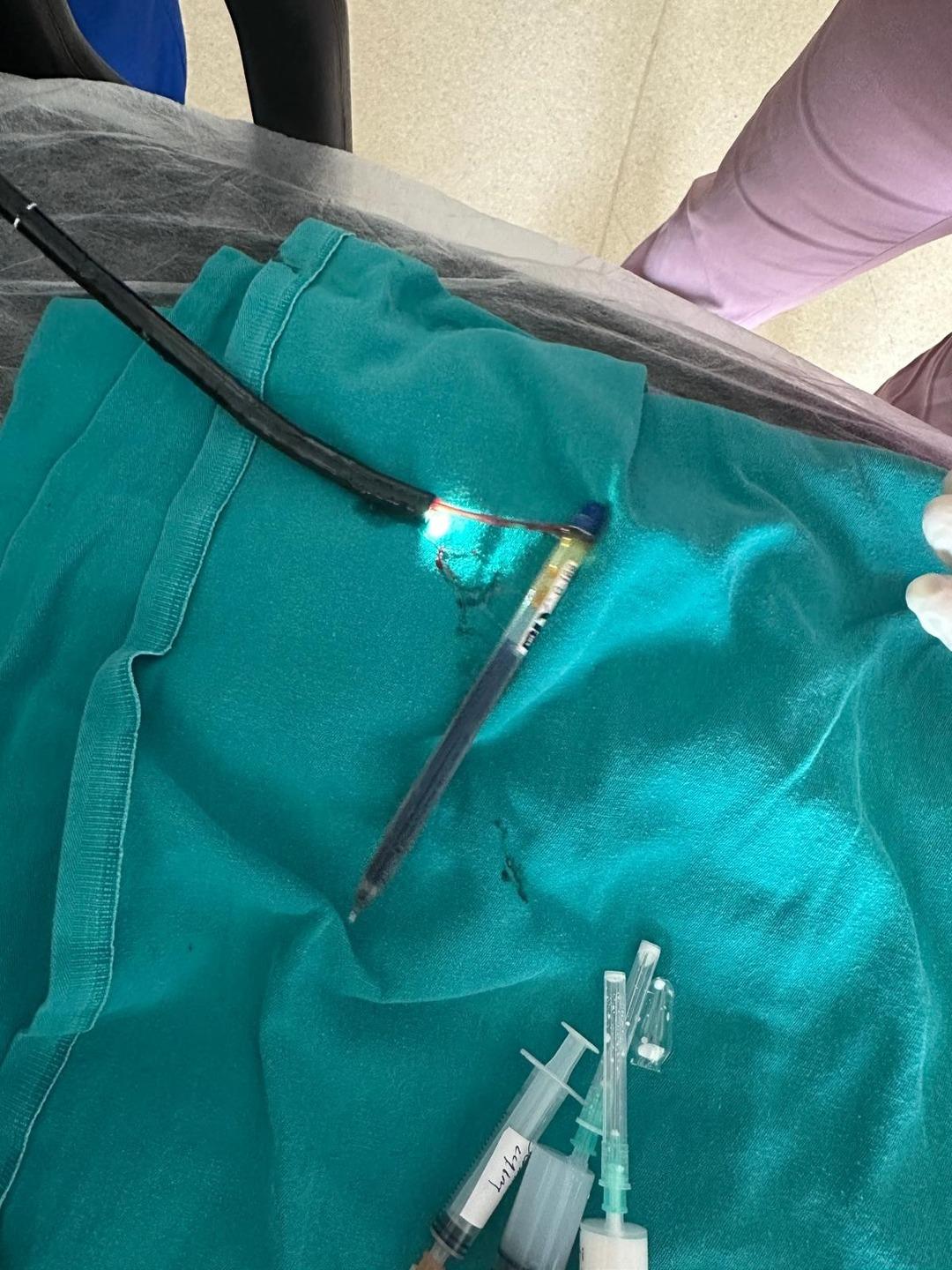 Genç kadının midesinden çıkanlar hayrete düşürdü: "Bu cisim ilk kez karşımıza çıktı" 1