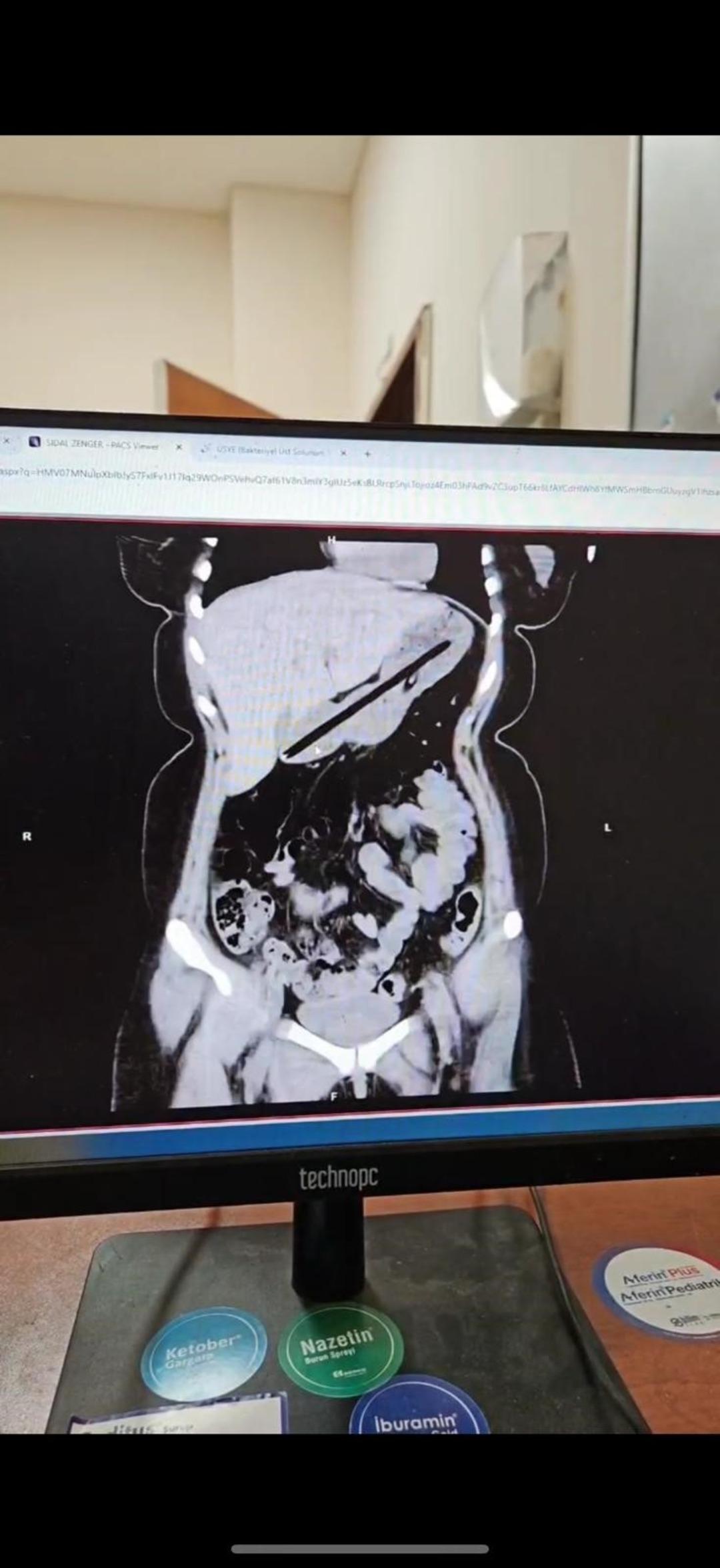 Genç kadının midesinden çıkanlar hayrete düşürdü: "Bu cisim ilk kez karşımıza çıktı" 4