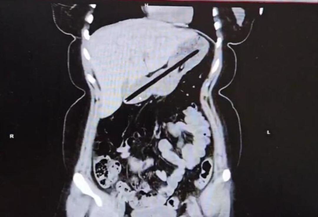 Ağrı şikayetiyle giden genç doktorları şaşkına uğrattı! Midesinden bakın ne çıktı 1