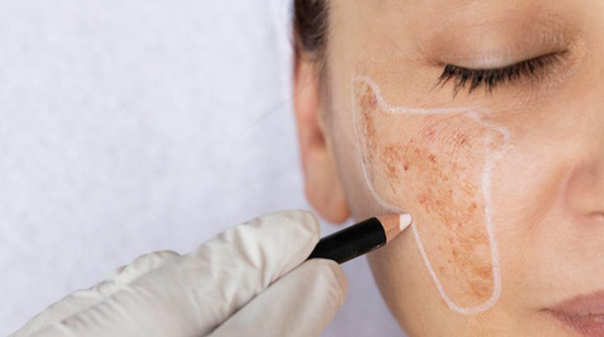 Cilt lekelerinde artış yaz sonrası artıyor! Uzmanından cilt lekelerine karşı uyarılar...