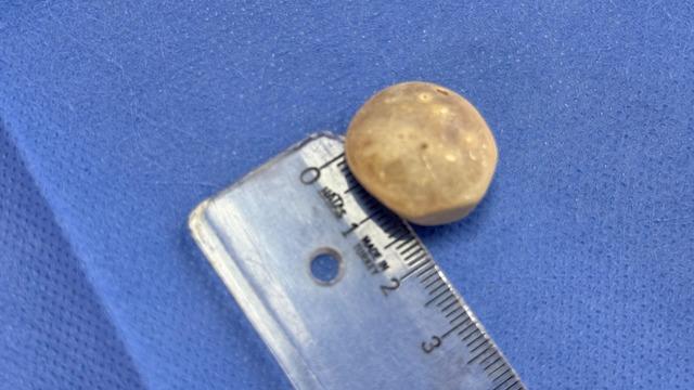 Hepsi vücudundan maden gibi çıkartıldı: Tam 287 tane! 2,5 santim boyutunda... 2