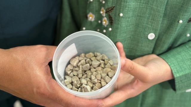 Hepsi vücudundan maden gibi çıkartıldı: Tam 287 tane! 2,5 santim boyutunda... 3