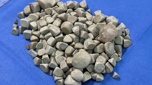 Hepsi vücudundan maden gibi çıkartıldı: Tam 287 tane! 2,5 santim boyutunda... 4