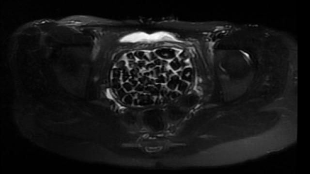 Hepsi vücudundan maden gibi çıkartıldı: Tam 287 tane! 2,5 santim boyutunda... 5