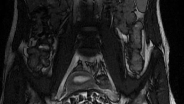 Hepsi vücudundan maden gibi çıkartıldı: Tam 287 tane! 2,5 santim boyutunda... 6